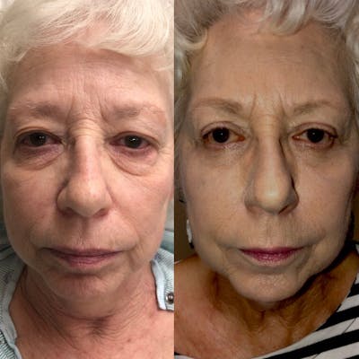 Lower Blepharoplasty Before & After Gallery - Patient 8523454 - Image 1