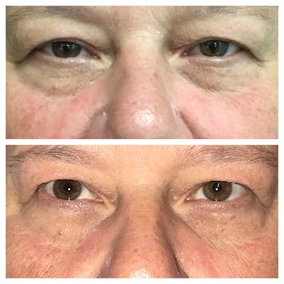 Lower Blepharoplasty Before & After Gallery - Patient 8523462 - Image 1
