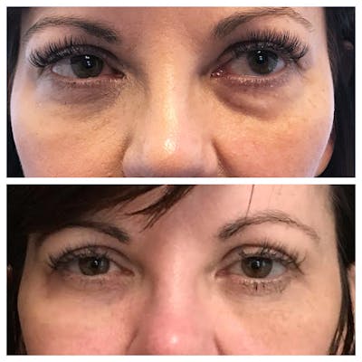 Lower Blepharoplasty Before & After Gallery - Patient 8523471 - Image 1
