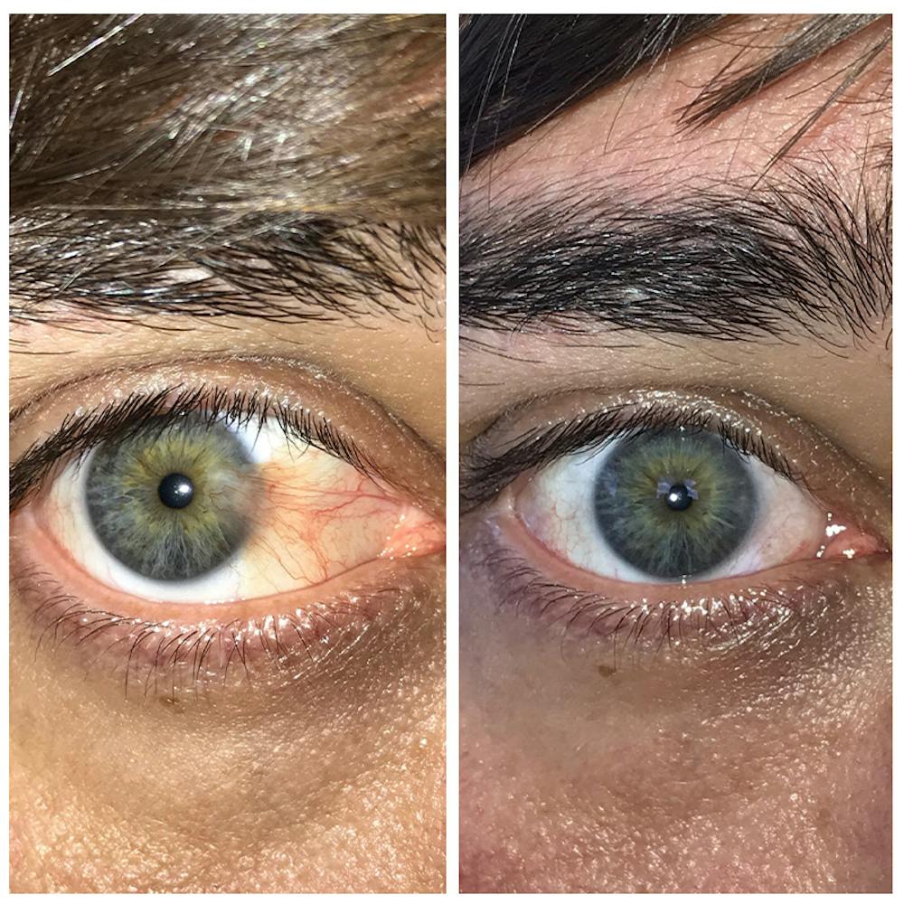 Pterygium Before & After Gallery - Patient 8523480 - Image 1