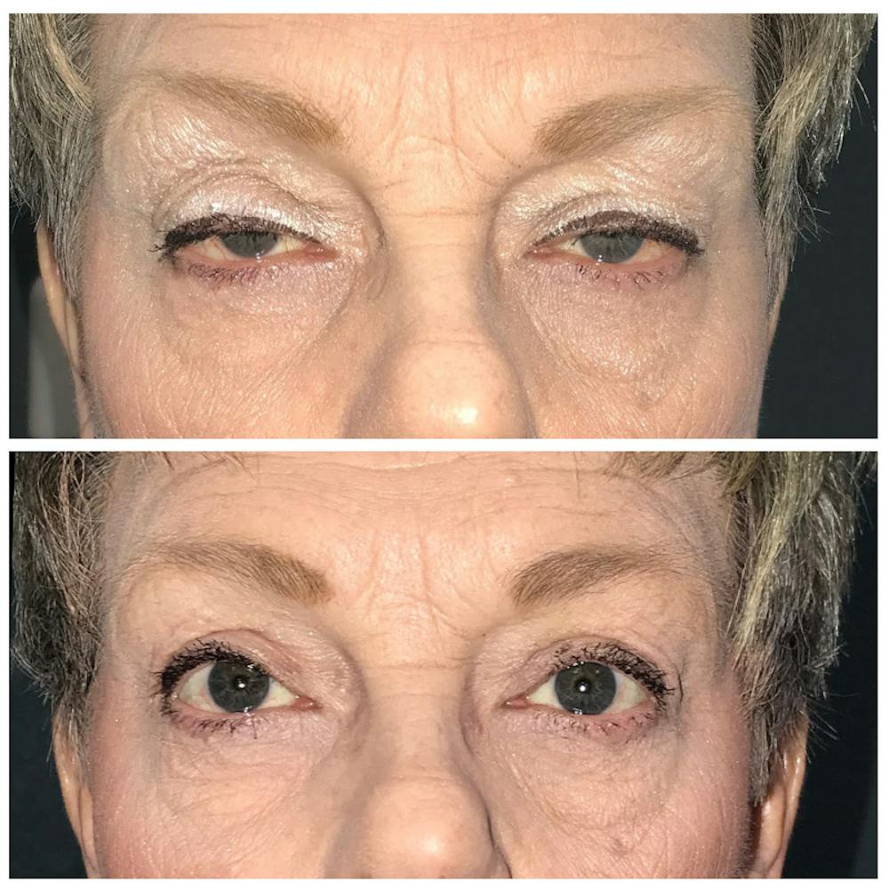 Ptosis Before & After Gallery - Patient 8523489 - Image 1