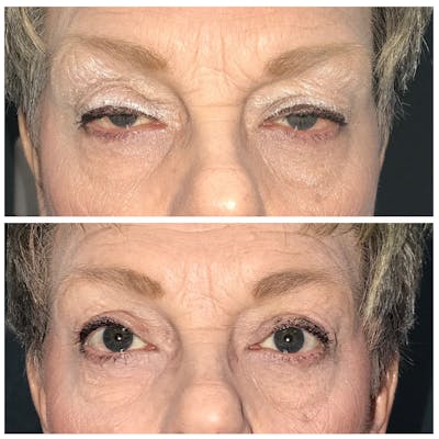Ptosis Before & After Gallery - Patient 8523489 - Image 1