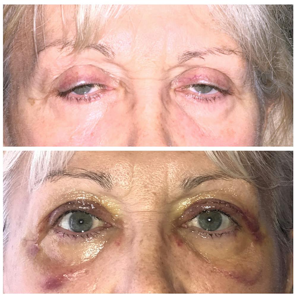 Ptosis Before & After Gallery - Patient 8523507 - Image 1