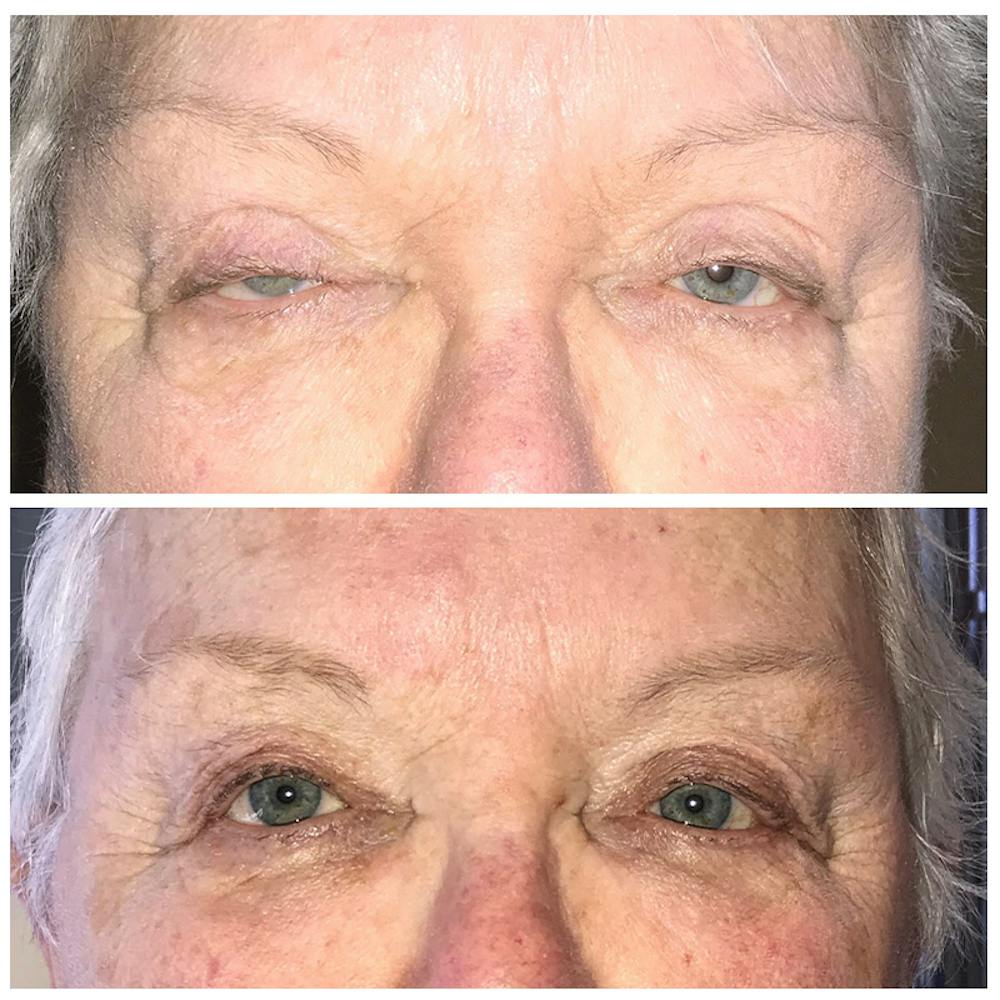 Ptosis Before & After Gallery - Patient 8523532 - Image 1