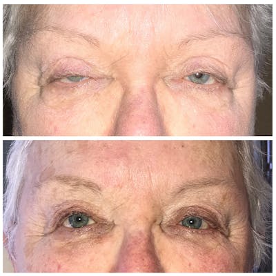 Ptosis Before & After Gallery - Patient 8523532 - Image 1
