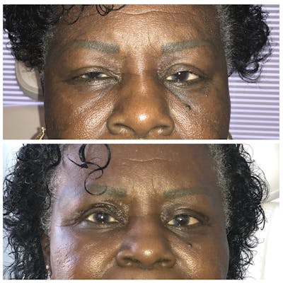 Ptosis Before & After Gallery - Patient 8523537 - Image 1