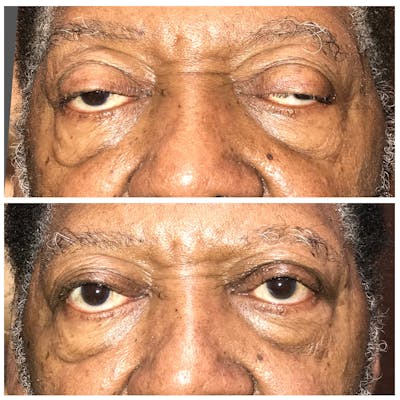 Ptosis Before & After Gallery - Patient 8523542 - Image 1