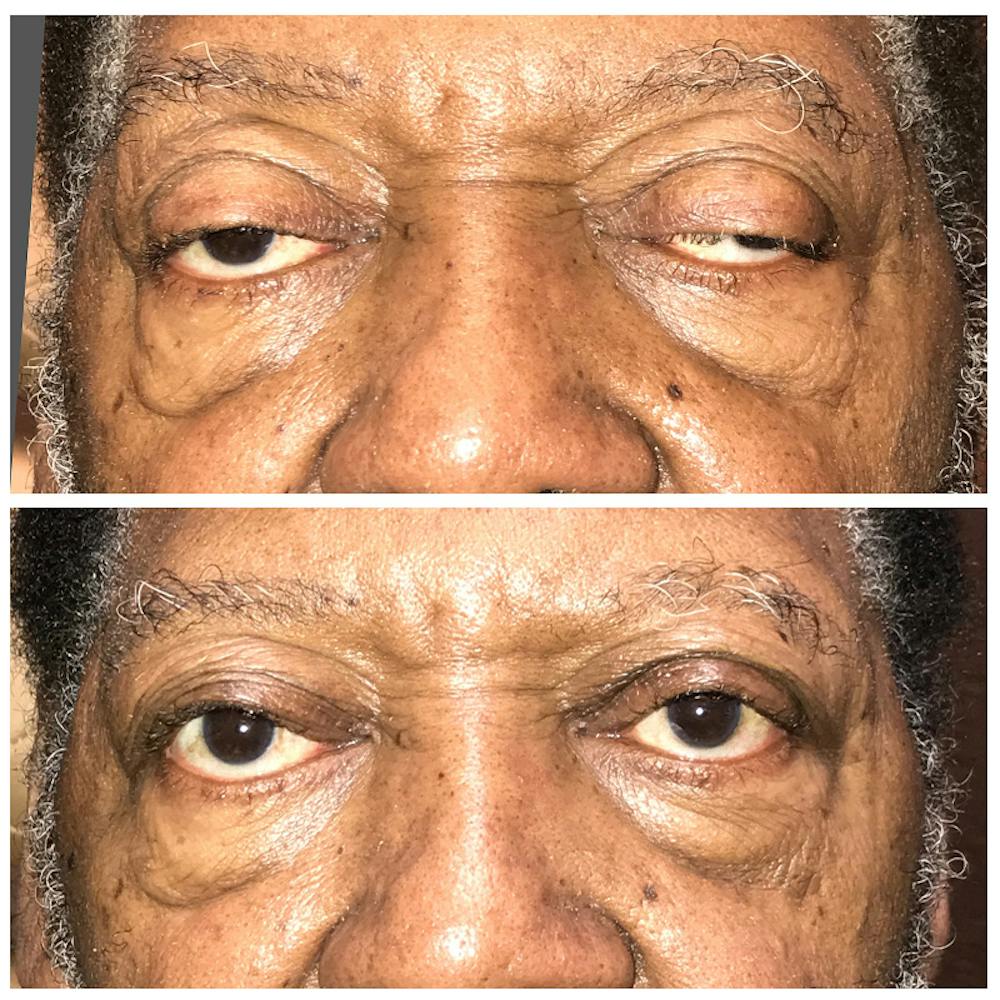 Ptosis Before & After Gallery - Patient 8523542 - Image 1