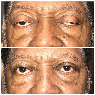 Ptosis Gallery - Patient 8523542 - Image 1