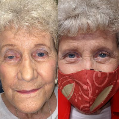 Ptosis Before & After Gallery - Patient 8523549 - Image 1