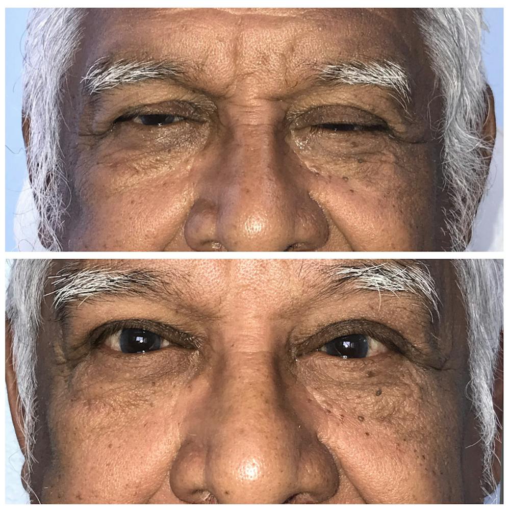 Ptosis Before & After Gallery - Patient 8523554 - Image 1