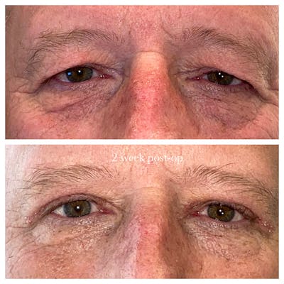 Ptosis Before & After Gallery - Patient 8523558 - Image 1