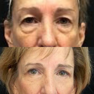Upper Blepharoplasty Before & After Gallery - Patient 8523564 - Image 1