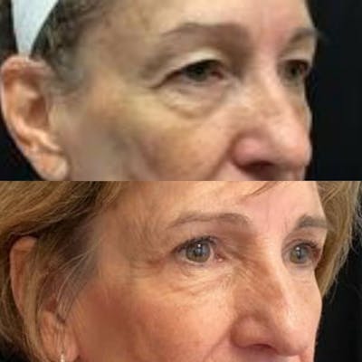 Upper Blepharoplasty Before & After Gallery - Patient 8523564 - Image 2