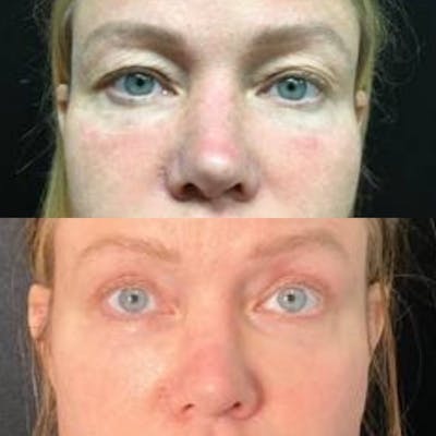 Upper Blepharoplasty Before & After Gallery - Patient 8523570 - Image 1