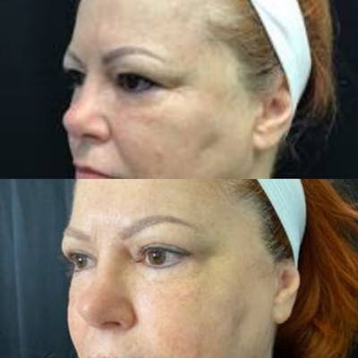 Upper Blepharoplasty Before & After Gallery - Patient 8523581 - Image 1