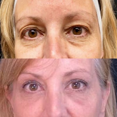 Upper Blepharoplasty Before & After Gallery - Patient 8523587 - Image 1