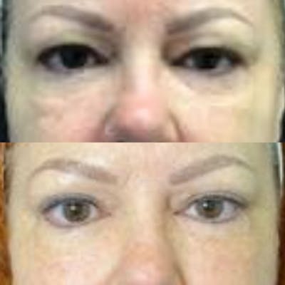 Upper Blepharoplasty Before & After Gallery - Patient 8523591 - Image 1