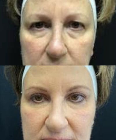 Upper Blepharoplasty Before & After Gallery - Patient 8523595 - Image 1
