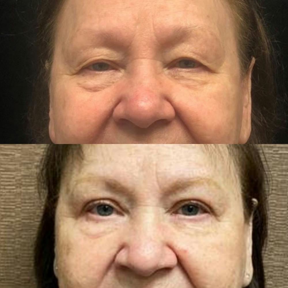 Upper Blepharoplasty Before & After Gallery - Patient 8523607 - Image 1