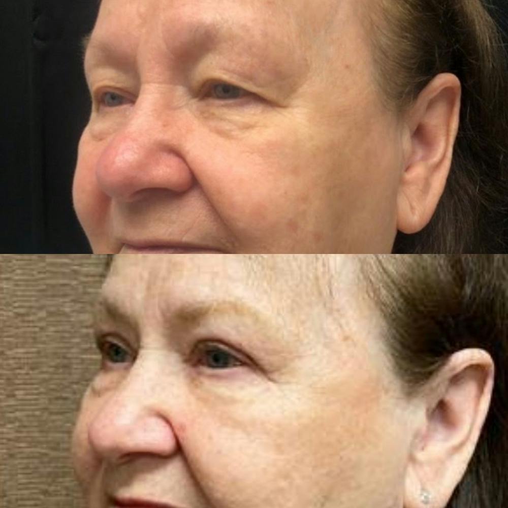 Upper Blepharoplasty Before & After Gallery - Patient 8523607 - Image 2