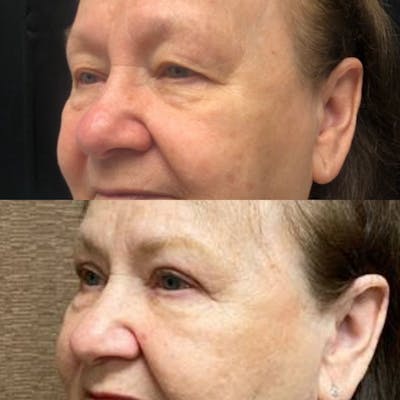 Upper Blepharoplasty Before & After Gallery - Patient 8523607 - Image 2