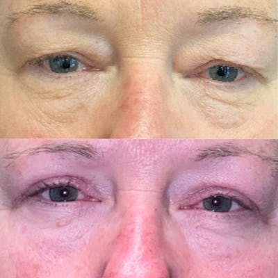 Upper Blepharoplasty Before & After Gallery - Patient 8523612 - Image 1