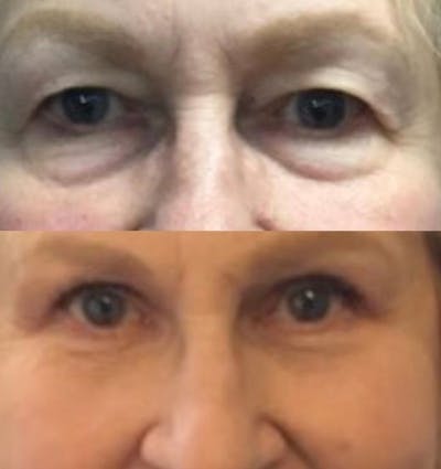 Upper Blepharoplasty Before & After Gallery - Patient 8523616 - Image 1