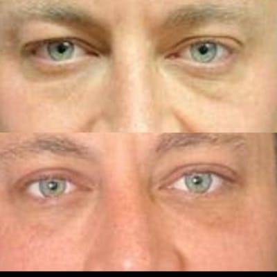 Upper Blepharoplasty Before & After Gallery - Patient 8523620 - Image 1