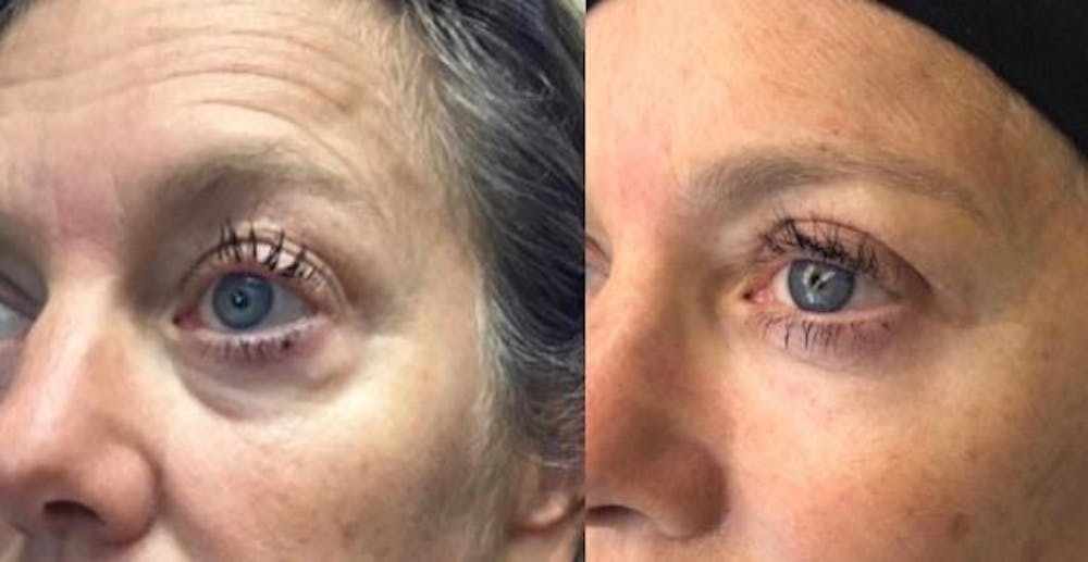 Upper Blepharoplasty Before & After Gallery - Patient 8523625 - Image 1