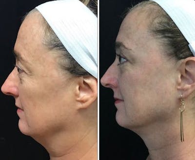 Upper Blepharoplasty Before & After Gallery - Patient 8523653 - Image 1