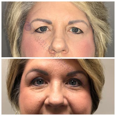 Upper Blepharoplasty Before & After Gallery - Patient 8523659 - Image 1