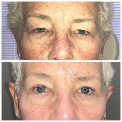Upper Blepharoplasty Before & After Gallery - Patient 8523662 - Image 1