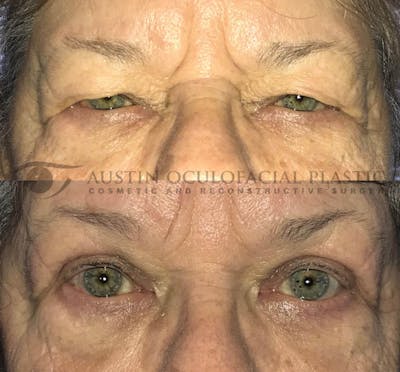 Upper Blepharoplasty Before & After Gallery - Patient 8523671 - Image 1