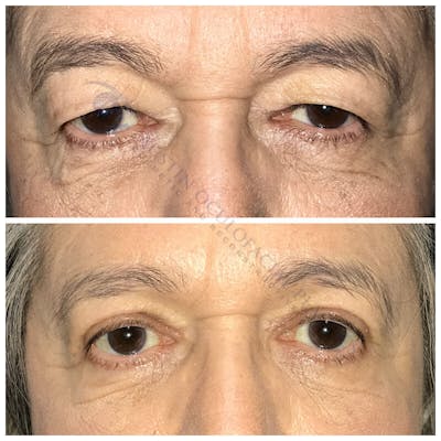 Upper Blepharoplasty Before & After Gallery - Patient 8523676 - Image 1