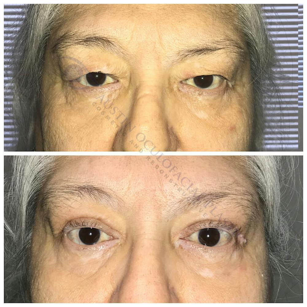 Upper Blepharoplasty Before & After Gallery - Patient 8523689 - Image 1