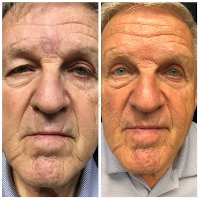 Upper Blepharoplasty Before & After Gallery - Patient 8523710 - Image 1