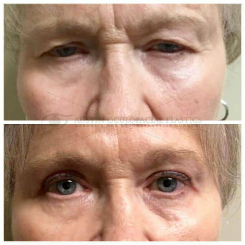 Upper Blepharoplasty Before & After Gallery - Patient 8523715 - Image 1