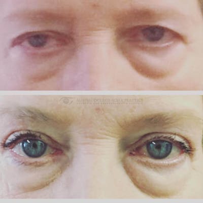 Upper Blepharoplasty Before & After Gallery - Patient 8523719 - Image 1