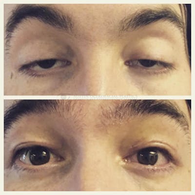 Upper Blepharoplasty Before & After Gallery - Patient 8523724 - Image 1
