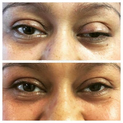 Upper Blepharoplasty Before & After Gallery - Patient 8523730 - Image 1