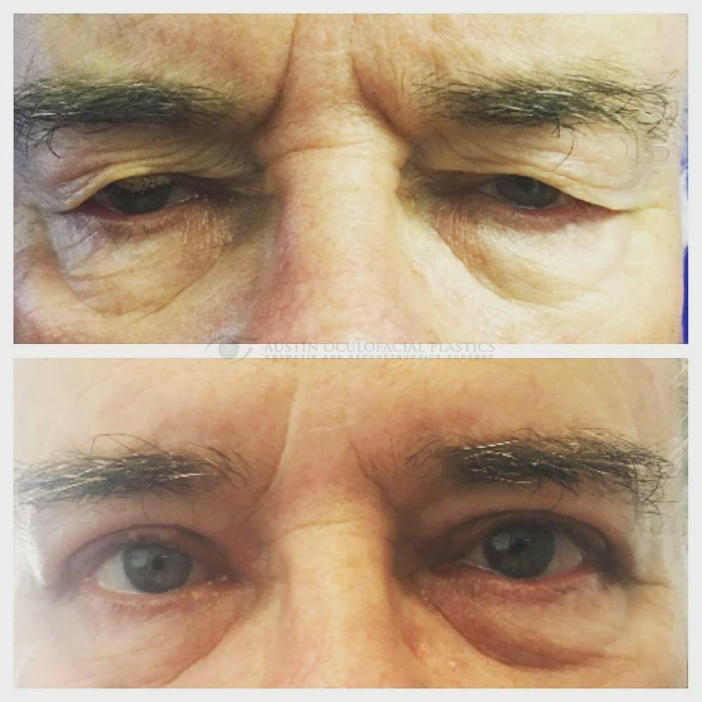 Upper Blepharoplasty Before & After Gallery - Patient 8523736 - Image 1