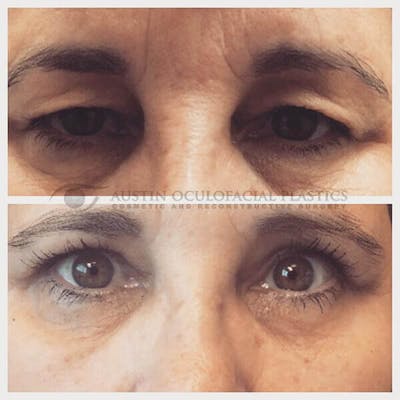 Upper Blepharoplasty Before & After Gallery - Patient 8523737 - Image 1