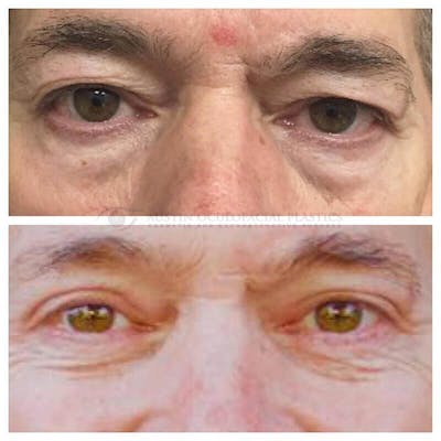 Upper Blepharoplasty Before & After Gallery - Patient 8523738 - Image 1