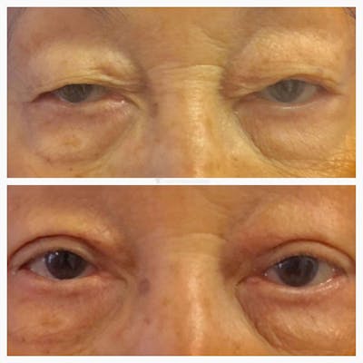 Upper Blepharoplasty Before & After Gallery - Patient 8523739 - Image 1