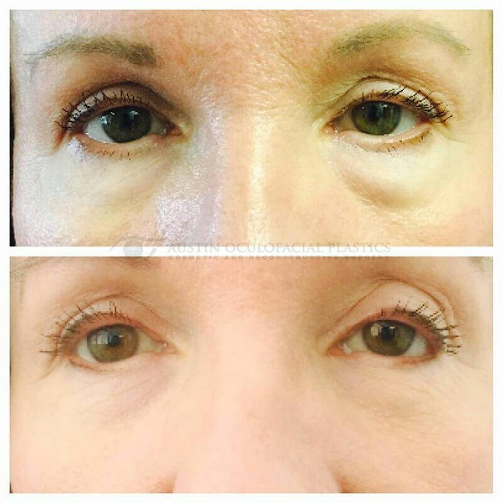 Upper Blepharoplasty Before & After Gallery - Patient 8523740 - Image 1