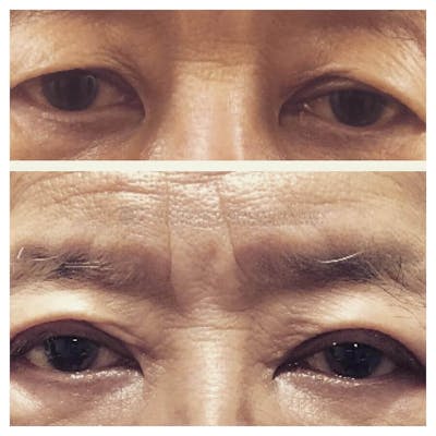 Upper Blepharoplasty Before & After Gallery - Patient 8523741 - Image 1