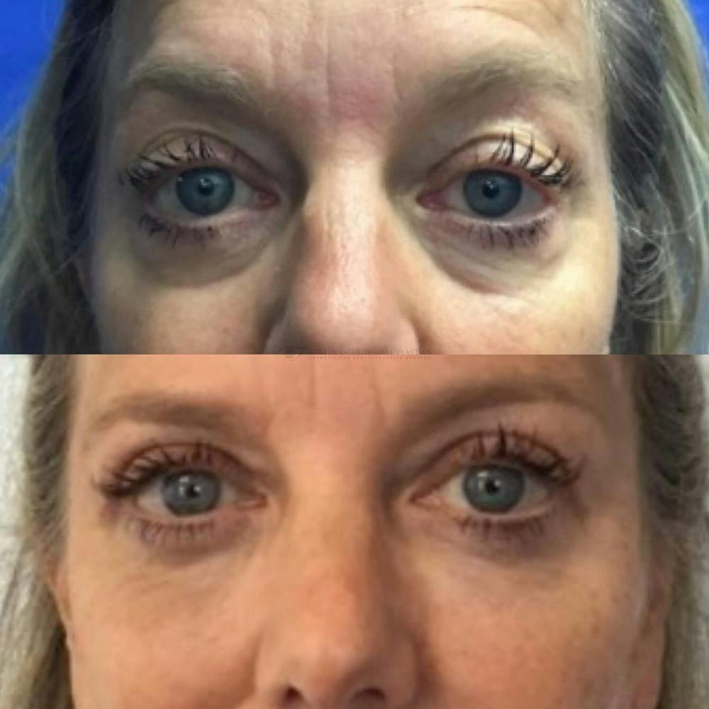Upper Blepharoplasty Before & After Gallery - Patient 8523742 - Image 1