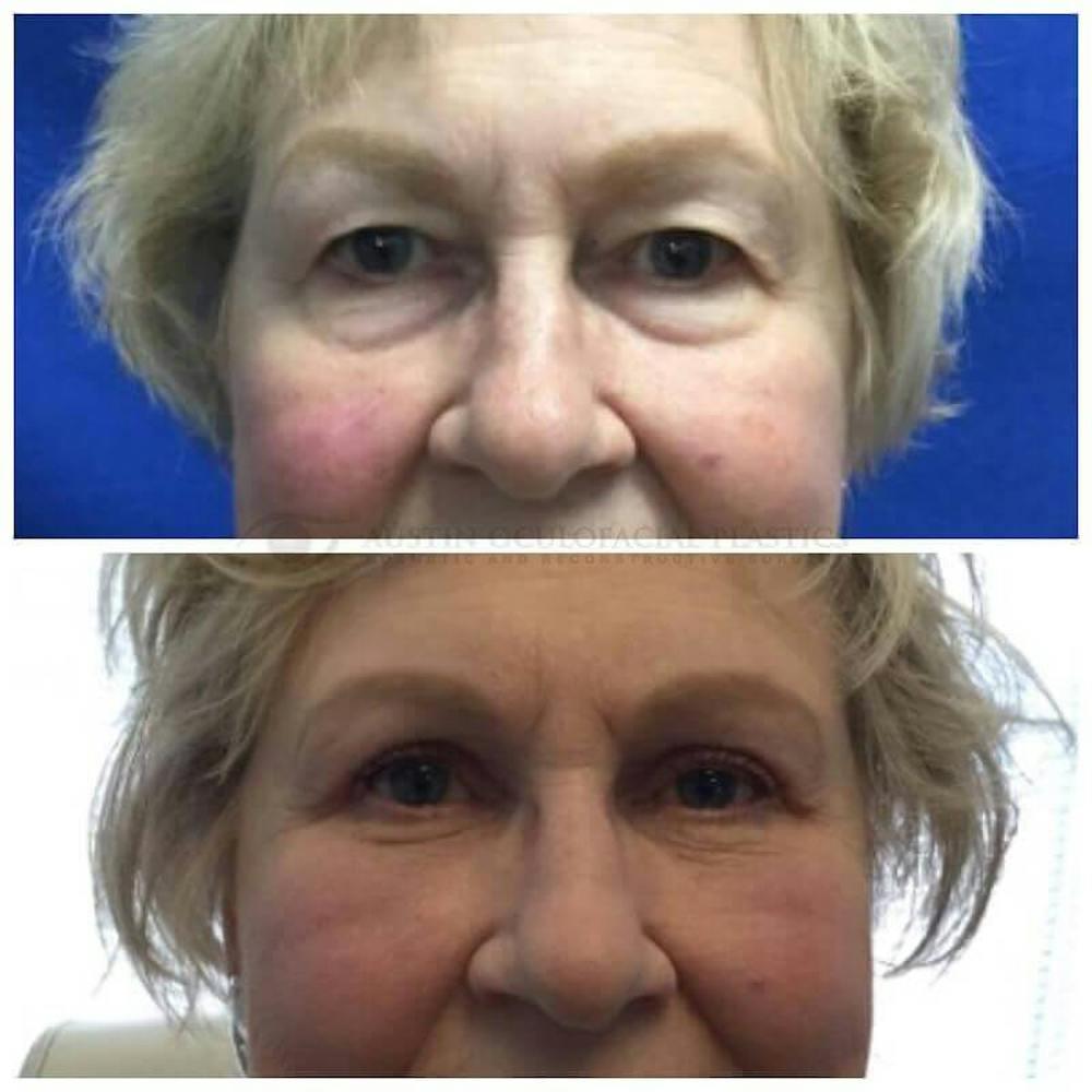 Upper Blepharoplasty Before & After Gallery - Patient 8523744 - Image 1