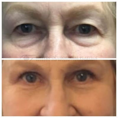 Upper Blepharoplasty Before & After Gallery - Patient 8523746 - Image 1